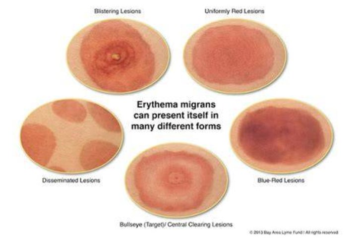 Can erythema migrans be small?