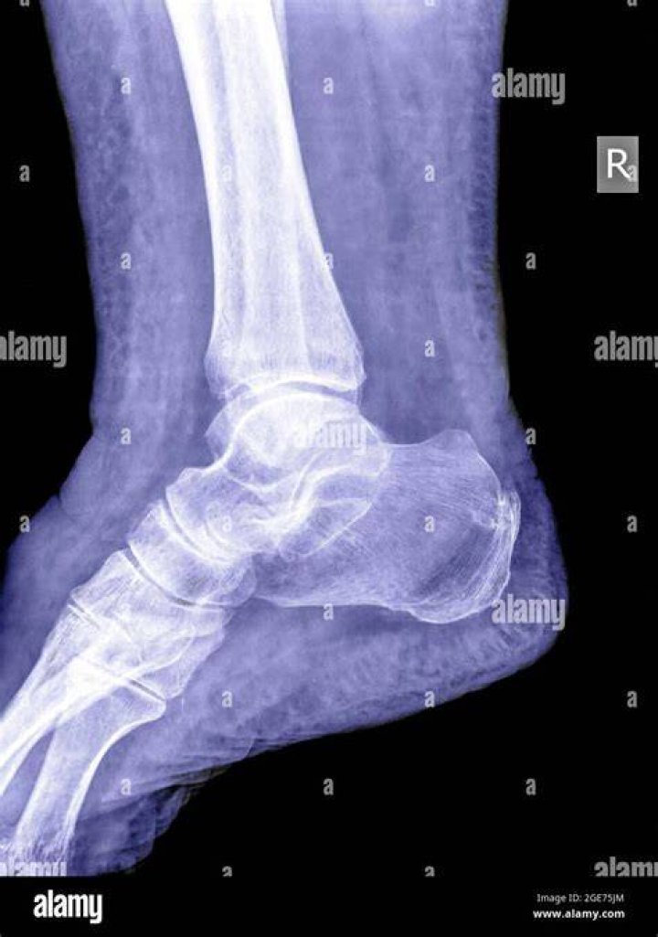 Can sprain be seen in an x ray?
