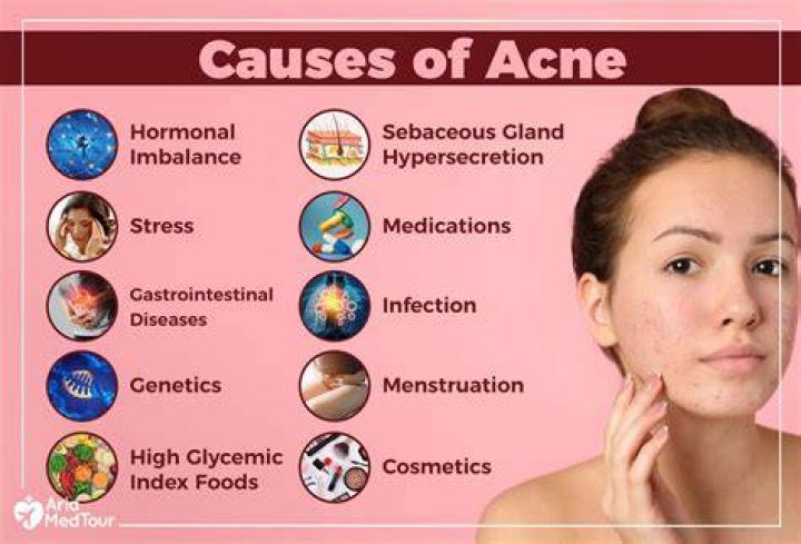 Do curd cause acne?