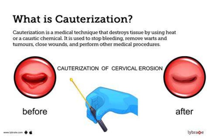 Does cauterizing a wound hurt?