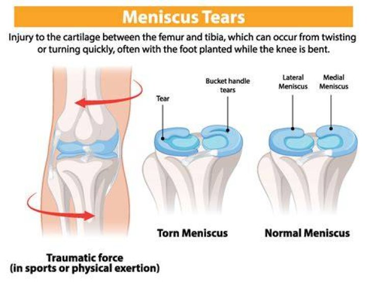 What does meniscus mean?