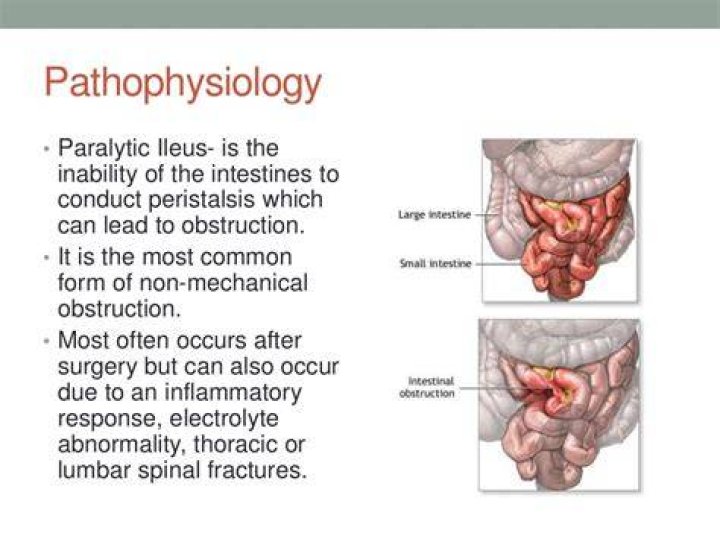 Why does hypokalemia cause paralytic ileus?